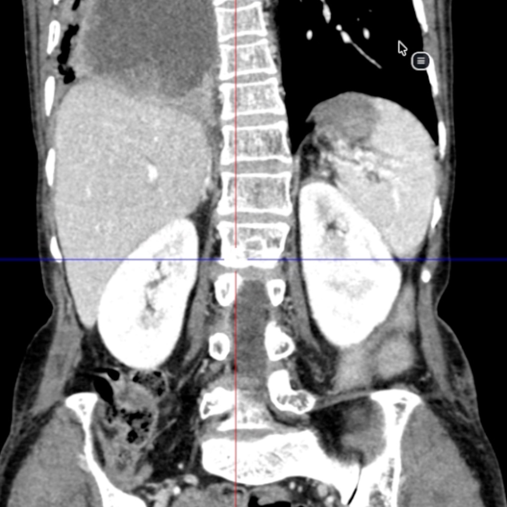 DN Viewer coronal reconstruction used to choose a spine slice for Cobb angle measurement