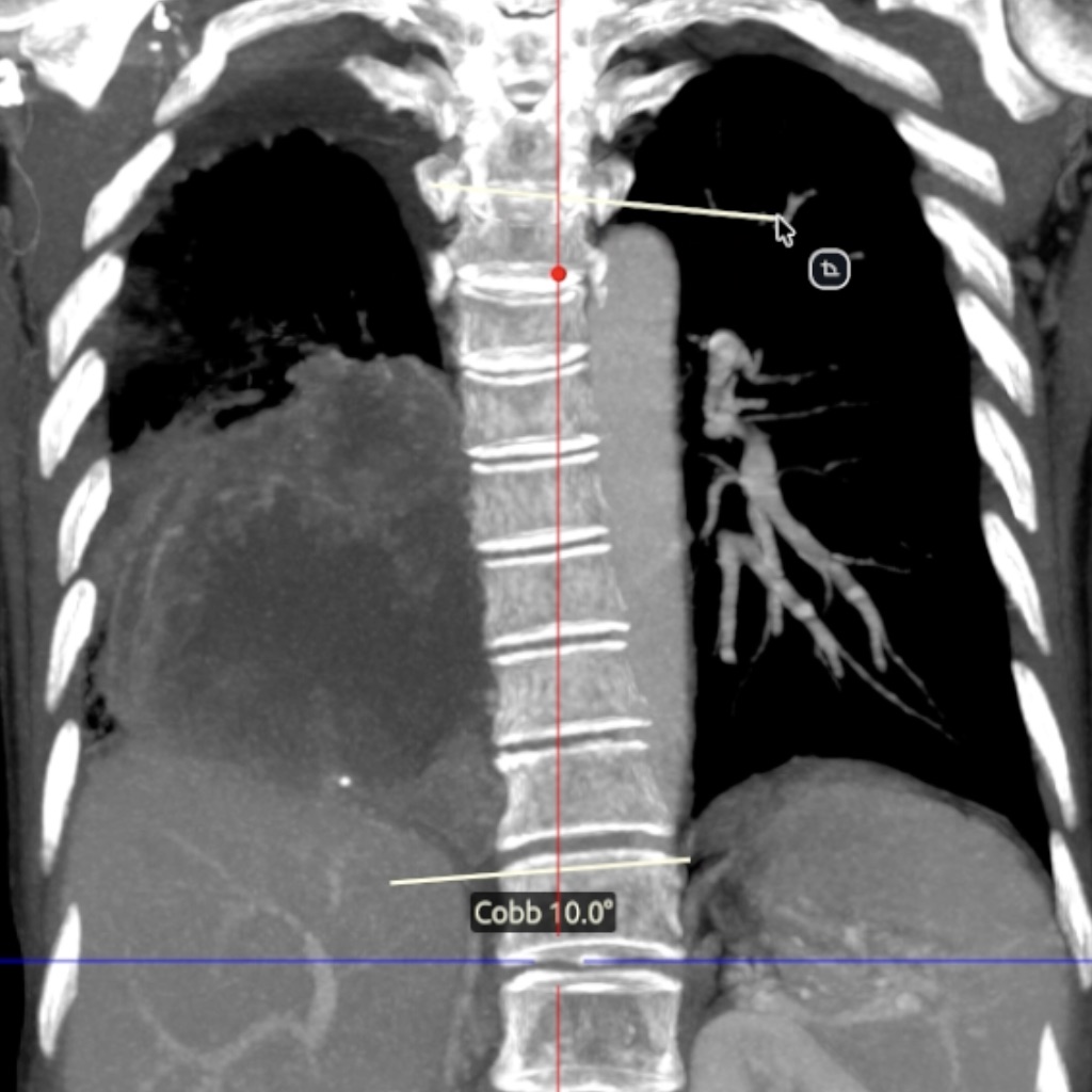 Cobb angle measurement lines shown on a coronal spine image in DN Viewer