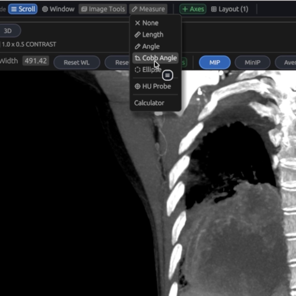 DN Viewer Measure menu with Cobb Angle selected